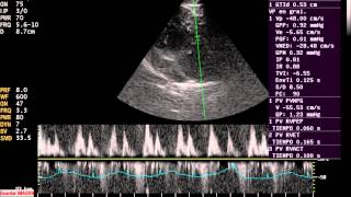 ENFERMEDAD VALVULAR MITRAL CANINOS [upl. by Ennaul]