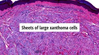 Pathology of Tendinous Xanthoma by Dr Sampurna Roy MD [upl. by Pammy]