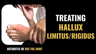 Hallux Limitus and Hallux Rigidus Treatment  Arthritis of the Big Toe Joint [upl. by Kennan]