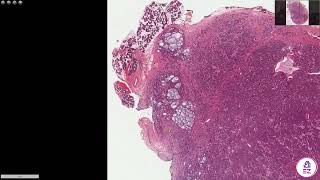 Adenoid Cystic Carcinoma [upl. by Sipple]