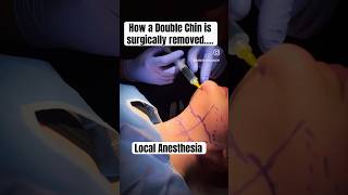 How to get rid of a double chin Austin Chin Lipo [upl. by Micheal101]