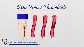 DVT Deep Venous Thrombosis Pathophysiology  Risk Factors  Presentation  Diagnosis  Management [upl. by Hephzipah]