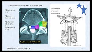 3 Key Ligaments of the Lumbar Spine and Their Related Pathology Disc Herniation Stenosis amp DISH [upl. by Younglove6]