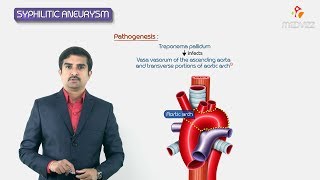 Syphilitic aneurysm  ascending aorta amp arch or aorta   Pathology Usmle step 1 Fmge and Neet Pg [upl. by Ecnaralc]