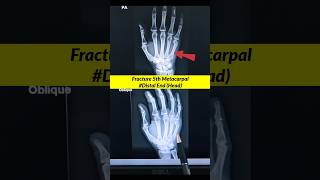 Fracture 5th Metacarpal ⚡️Xray Hand xray radiographerusn radiography shorts [upl. by Licko]