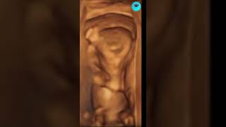 3D Ultrasound of fetal movements at 12 weeks pregnancyjourney pregnancy pregnancytips [upl. by Hgielrac]