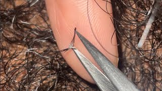 Ingrown and Compound Hair Extractions😍 [upl. by Emarie]