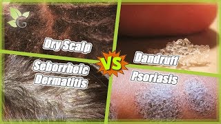 Dry Scalp vs Dandruff vs Seborrheic Dermatitis vs Psoriasis [upl. by Anavoj845]