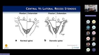 Indications Neurogenic Claudication amp Lateral Recess Stenosis  Phil Fagan MD [upl. by Adley412]