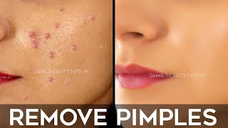 How to Remove Pimples Overnight  Pimple Remedy Beauty Tips in Tamil  Minmini [upl. by Waller190]