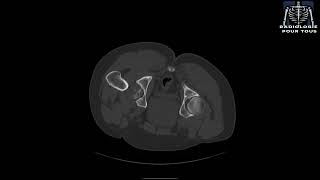 SCANNER DE LA HANCHE Fracture comminutive complexe de la hanche avec luxation [upl. by Compte]