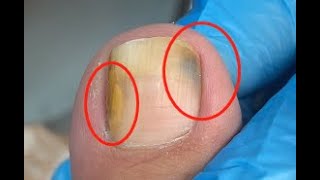 Toenail turns into black and yellow due to fungus [upl. by Jacki]