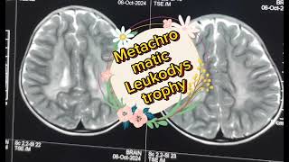 Metachromatic Leukodystrophy by DrMdOmar Faruk [upl. by Noside147]