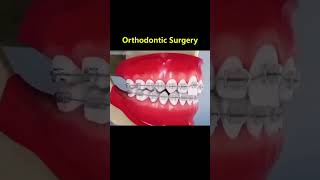 Ortho Treatment open bite العلاج التقويم للعظه المفتوحه 🎖️👌 [upl. by Ithsav801]