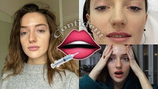 first time lip filler 1ml Therapie Clinic BLUEWATER [upl. by Zosima]