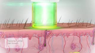 SYNERON CANDELA  Gentle Hair Removal biological animation [upl. by Roane548]