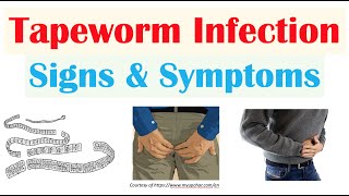 Tapeworm Infection Signs amp Symptoms Nutrient Deficiencies amp Complications [upl. by Ahseela313]