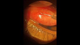 Management of Conjunctival Concretions [upl. by Adnuhsal]