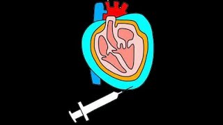 Cardiac Tamponade OverviewDr Pradeep Rangappa [upl. by Leavitt]