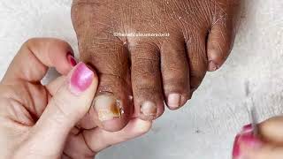 Lets Revisit  How to Pedicure on Tight Toenails [upl. by Kellen]