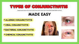 Types of conjunctivitis Allergic conjunctivitis Bacterial conjunctivitis Viral conjunctivitis [upl. by Anaitit]