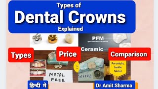 Dental Crowns Types Price amp Comparison  Explained in hindi Eng Subtitle [upl. by Ijar]