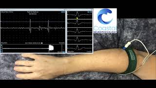 Needle EMG demonstration [upl. by Tannen]