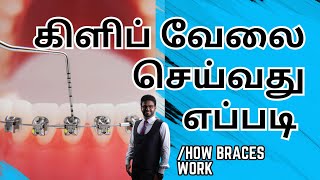 கிளிப் சிகிச்சை வேலை செய்வது எப்படி How BRACES WORK in tamil [upl. by Blalock323]