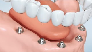 Replacement of all teeth Fixed denture  Did you know [upl. by Tannenwald]