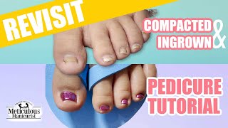 Revisiting the Deep Compacted Ingrown Toenail [upl. by Lil]