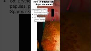 How to differentiate diaper dermatitis [upl. by Nannek]