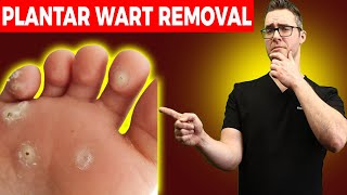 1 BEST Plantar Wart Removal How To Get Rid of Warts Treatments [upl. by Streeter]