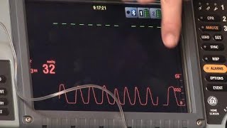 Waveform Capnography [upl. by Mook879]