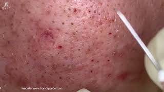 Big Cystic Acne Blackheads Extraction Blackheads amp Milia Whiteheads Removal Pimple Popping [upl. by Asirahc]