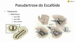 Pseudartrose e Cirurgia Escafóide  TARO [upl. by Jordison694]