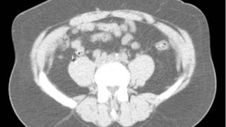 Ureteral Stone with Obstruction DISCUSSION by a Radiologist [upl. by Opportuna]