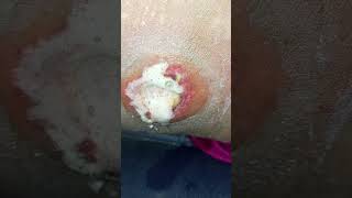 complete dressing pyoderma gangrenous [upl. by Faux]