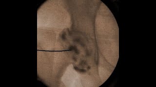 IntraArticular Hip Injection Using Anatomic Surface Landmarks [upl. by Hsoj673]