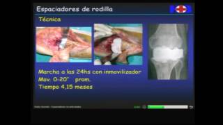 HDR 2016 Dr German Viale Espaciadores de rodilla no articulados [upl. by Oyek866]