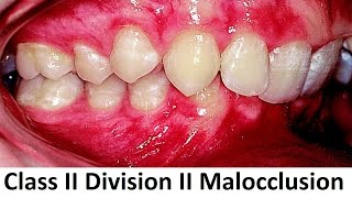 Can Class II Division II of Malocclusion Be Treated With Orthotropics by Prof John Mew [upl. by Nomis842]