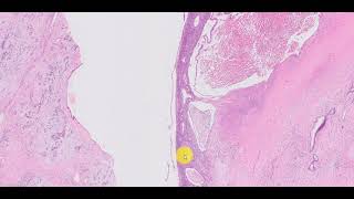 Mucinous cystic neoplasm pancreas [upl. by Ekrub]