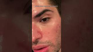 Youll wish you did this sooner skincaretips beforeandafter dryskin dryskinrelief dryair [upl. by Conney]