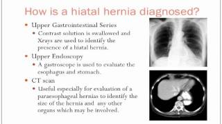 Hiatal Hernias [upl. by Lord144]