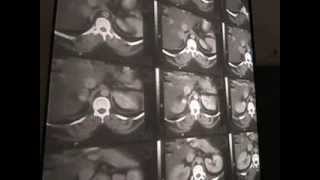 Endocrine Surgery  Adrenal Glands 1  Imaging [upl. by Ahnavas]