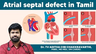 Atrial septal defect in tamil  treatment for atrial septal defect doctoradithacibi [upl. by Aili520]