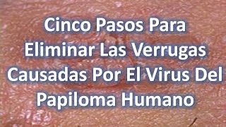 Remedios Caseros Para Eliminar Las Verrugas Causadas Por El Virus Del Papiloma Humano [upl. by Wileen]