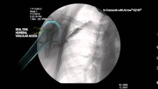 Arrow® EZIO® Infusion Fluoroscopy Proximal Humerus MC000631 [upl. by Eissen752]