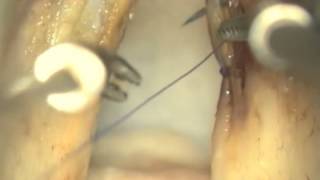 ruptrued cyst advanced flapmp4 [upl. by Ellehcear36]