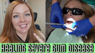 My Experience With SEVERE Gum Disease Periodontal disease diagnoses treatments amp natural healing [upl. by Ahsrav]