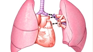 Idiopathic Pulmonary Fibrosis Lung Transplants [upl. by Tterrag]